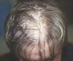 dr amar greffe cheveux implant capillaire