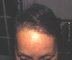 greffe cheveux implant femme